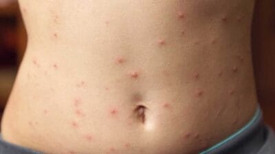 25 yaygin cilt hastaligi bursa natural klinik