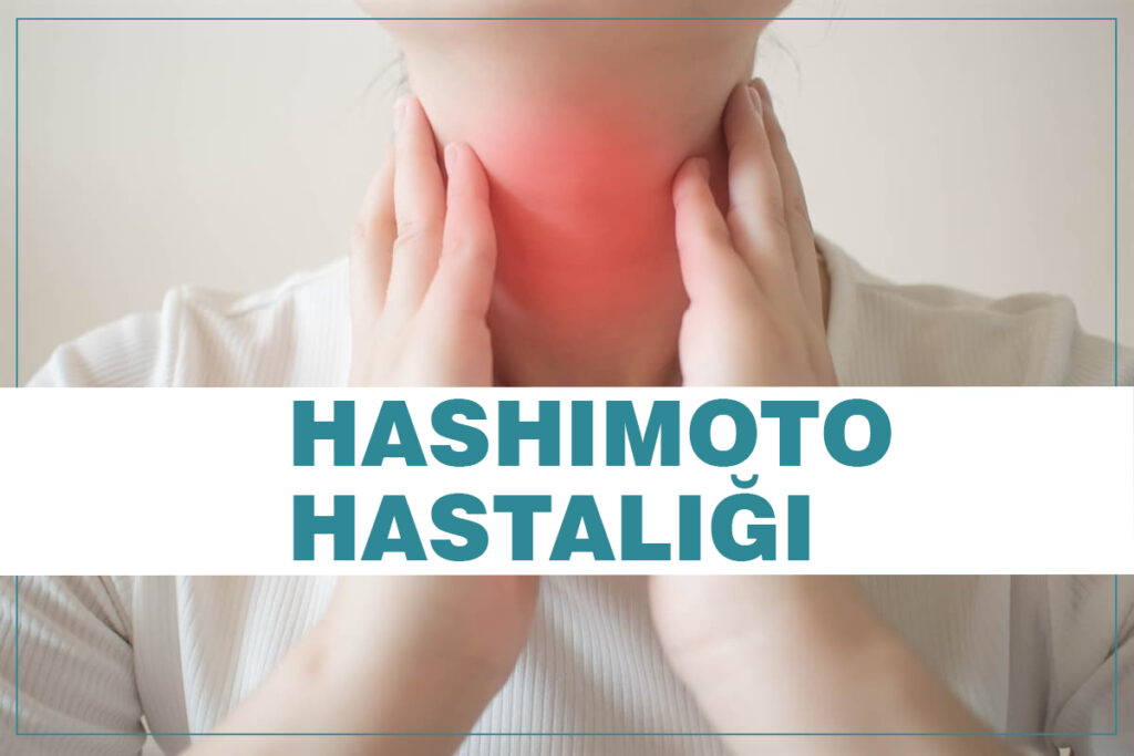 Hashimoto Hastalığı